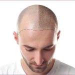 Come coprire una cicatrice sulla testa? Tricopigmentazione